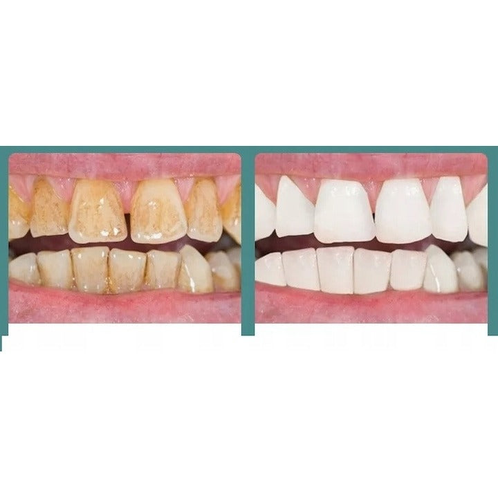 Scaler Ultrasonic Dentar cu LED – 3 Moduri Intensitate, 2 Capete Inox, Curățare Tartru & Placă Acasă